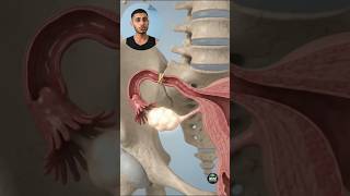 Permanent Birth Control Surgery | Tubectomy | Why are Fallopian Tubes Blocked? #Tubectomy