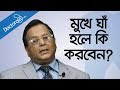Mouth ulcers home remedy - Mouth ulcers treatments - What causes mouth ulcers - Health Tips Bangla