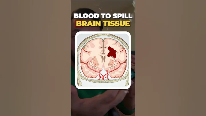 How a brain bleed can happen unexpectedly #medical #hypertension #doctor #neurosurgery #awareness