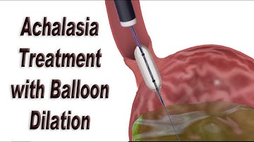 Achalasia Treatment with Endoscopic Balloon Dilation