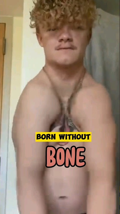 Born without Bones #shorts #bones