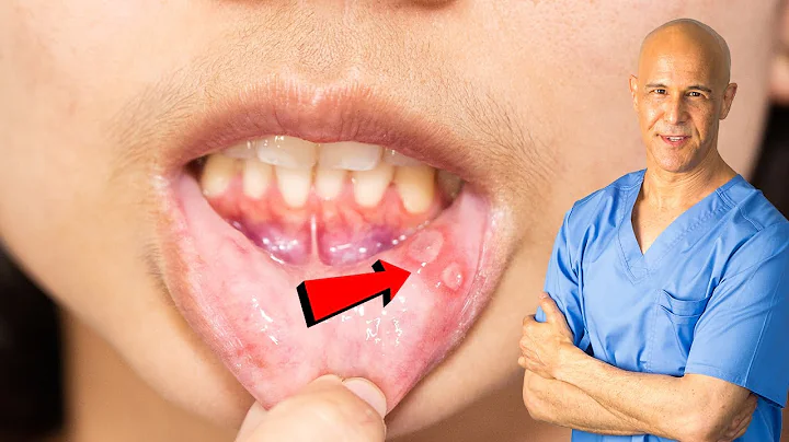 How I Quickly Healed My Canker Sore | Dr. Mandell - DayDayNews