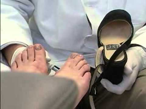Plantar Fasciitis