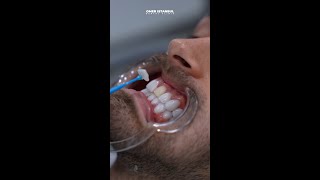 The Process Behind the Perfect Smile | The Art of Veneer Placement at Omer Istanbul