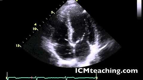 Apical 4 Chamber normal
