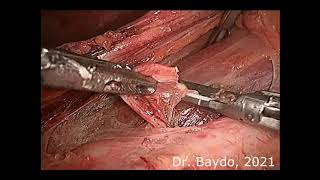 Laparoscopic left paraaortal LND