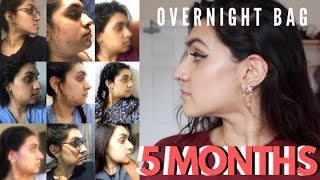 5 MONTHS POST DOUBLE JAW SURGERY | WHAT I PACKED IN MY NIGHT BAG! | ZARAS WORLD |