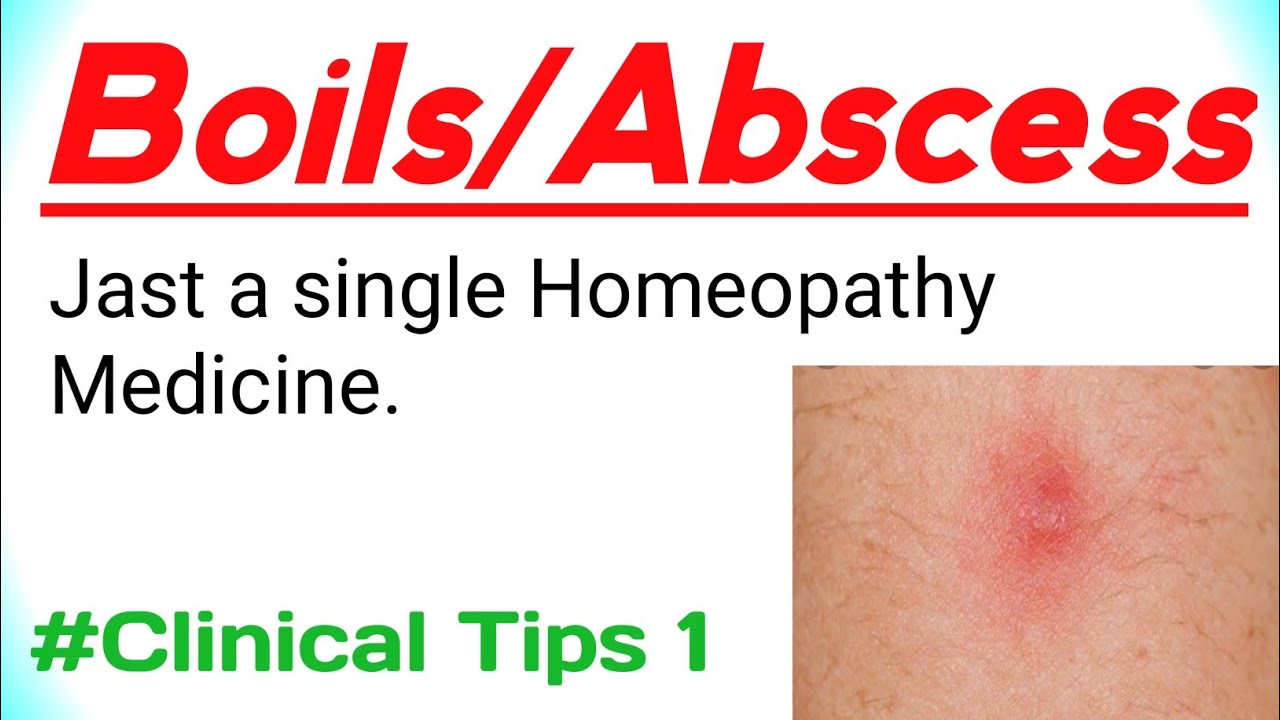 boils-homeopathic-medicine-in-bengali-hepar-sulph-fol-boils-clinical