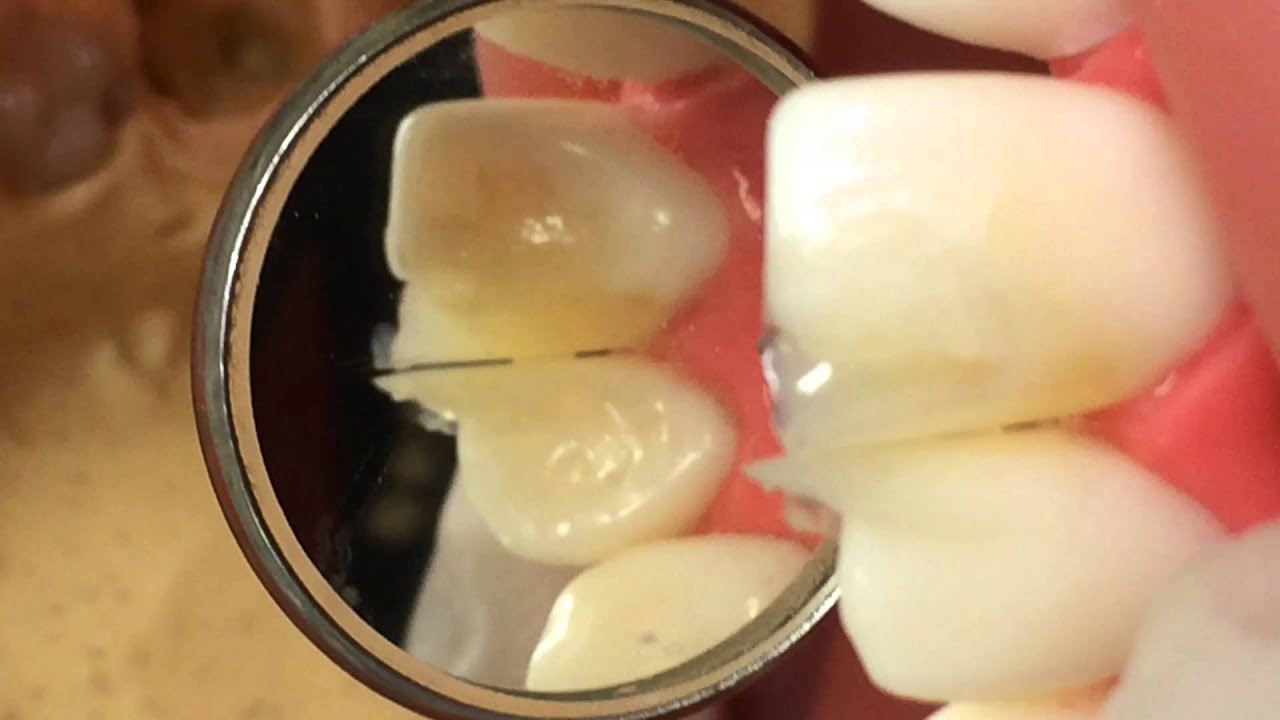 CR治療(9/14)隣接面窩洞が唇側まで及ぶ場合の充填