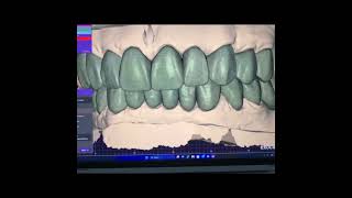 Explore the latest advancements in digital dental technology with Exocad software.