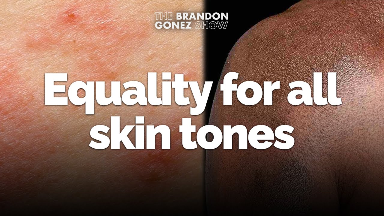 Eczema affects all skin tones, but the effects on darker skin are