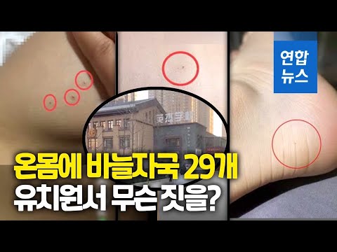 &amp;quot;우리 애 몸에 바늘자국 29개&amp;quot;…중국 <strong>유치원생</strong> 학대 논란 / 연합뉴스 (Yonhapnews)