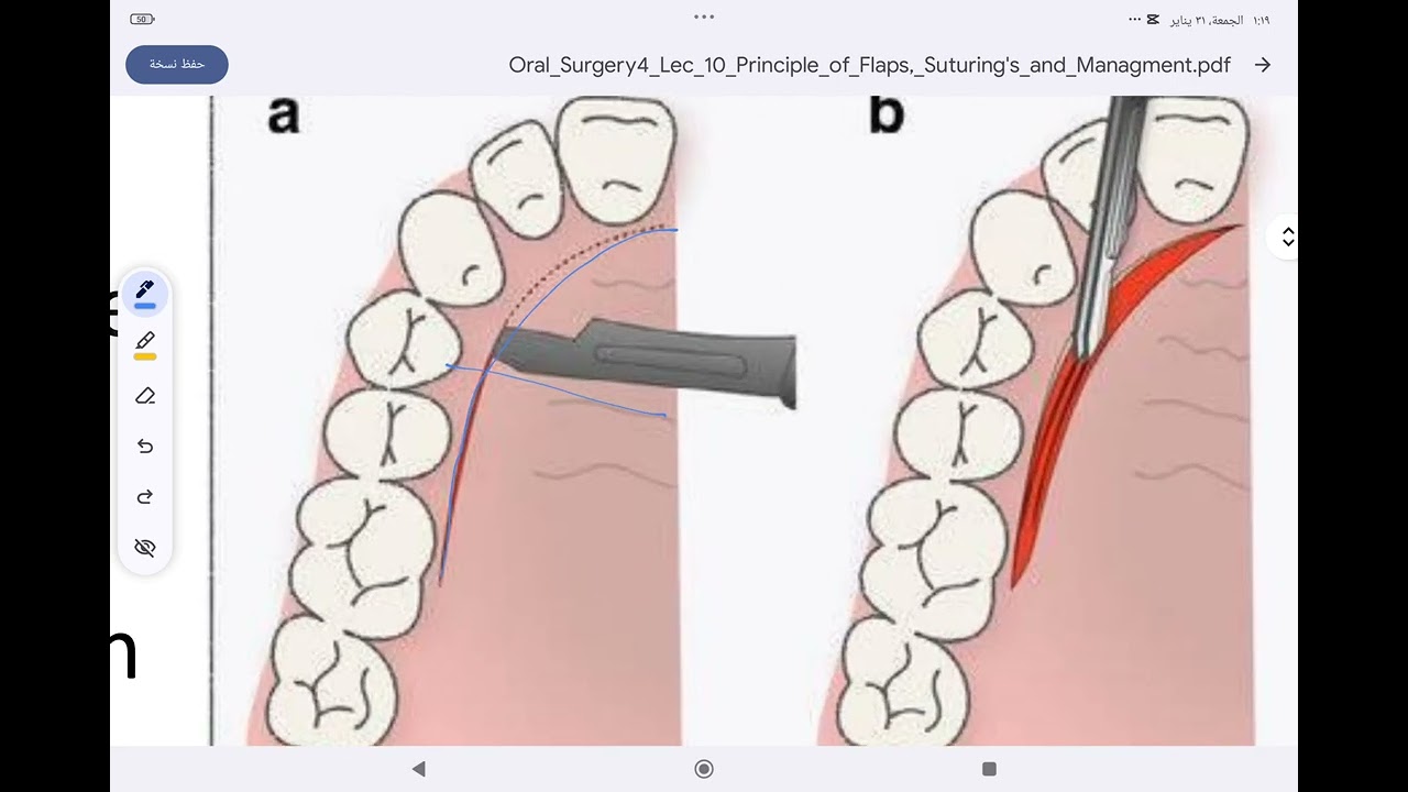 oral surgery lec(principle of flap.suturing and management of difficult extraction)مرحلة رابعة أسنان