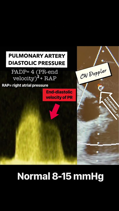 Assessment of pulmonary artery pressure by echocardiography. Pulmonary Hypertension.