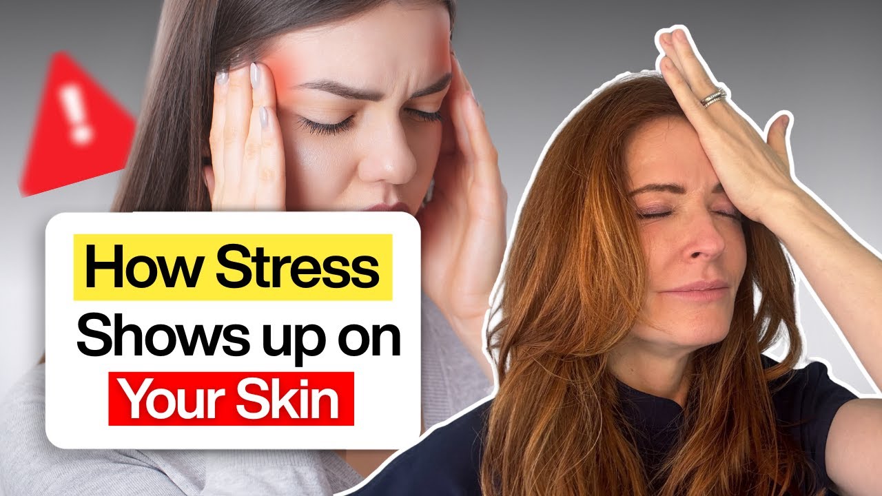 Is Stress Flaring up Your Skin?