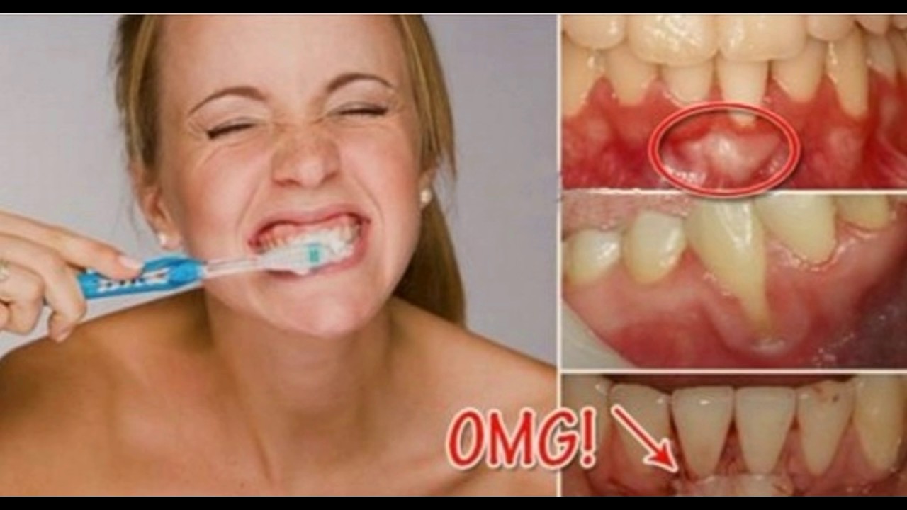 Carie Anche Se Mi Lavo I Denti THIS IS WHAT WILL HAPPEN IF YOU BRUSH YOUR TEETH VERY FAST| TOOTH DECAY