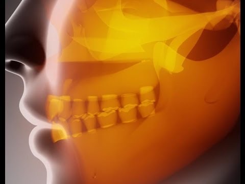 Trigeminal Neuralgia Causes and Treatment | Dr. Dong Kim, Mischer Neuroscience Institute. 
