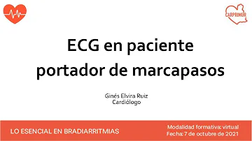 ¿Cómo se soluciona la fibrilación auricular con un marcapasos?