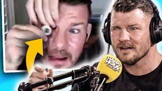 How UFC Champion Michael Bisping LOST HIS EYE In Fight!