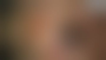 Scleral fixation of subluxated IOL with 4 flanged technique