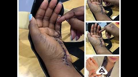 Flexor Tendon Injury