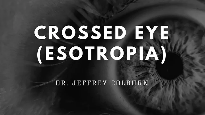 Crossed-Eye (Esotropia) - Dr. Jeffrey Colburn