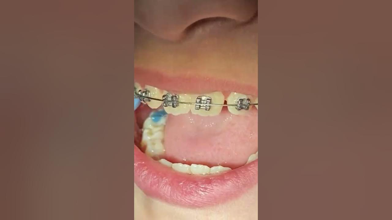do all braces get colors