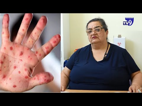 რა სიმტომები ახასიათებს \"მაიმუნის ყვავილს\"? - ინფექციონისტის განმარტება