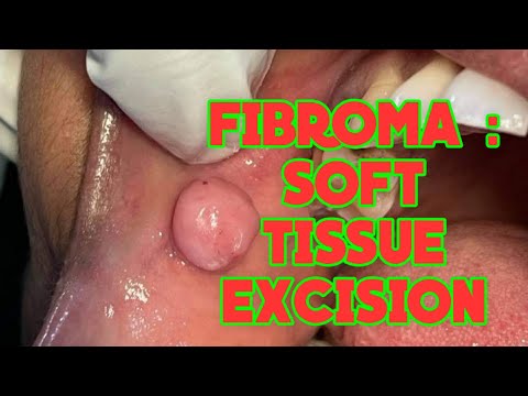 Fibroma | Excisional soft tissue biopsy | buccal mucosa