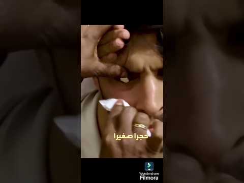 مقطع عجيب لمعالجة تخرج حصى من العين