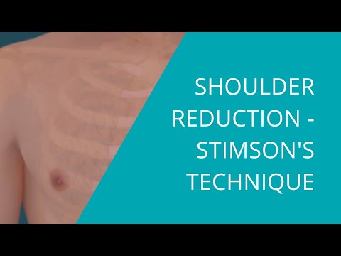 Shoulder Reduction Stimson's Technique