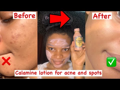 Trying out calamine lotion for Acne and dark spots for the first time/ Get rid of pimples✨