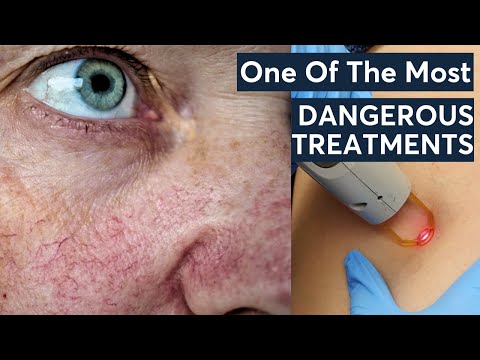 Hate Your Veins? Must-Watch Advice Before Your Removal Session!
