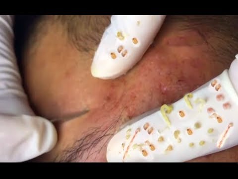 Can You Pop Cystic Acne?  World&#;s Greatest Medical!