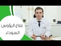 علاج الرؤوس السوداء | مع الدكتور كوستي