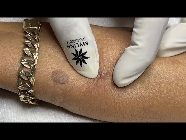 Arm acne with Linh My Dang #294 (Linh My Dang)U90