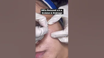 Milia Are Tiny Yellowish Whitish Balls Made Up Of Keratin They Are Not Itchy Or Painful Shorts 