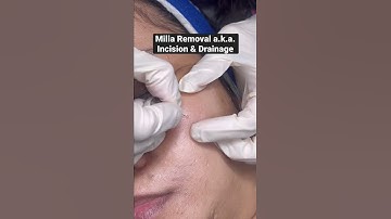 Milia are tiny yellowish/whitish balls made up of keratin. They are not itchy or painful. #shorts