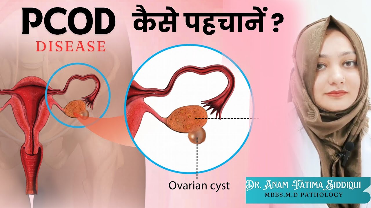 PCOD kaise pehchane | PCOD Test| PCOD Treatment|by Dr. Anam Fatima ...