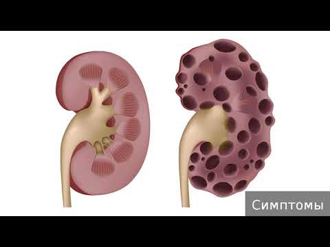 Поликистоз почек. Как лечить поликистоз почек.