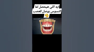 ايه اللي هيحصل لما التسوس يوصل للعصب وايه الحل التجمع الخامس المهندسين د عبدالسلام محمد 
