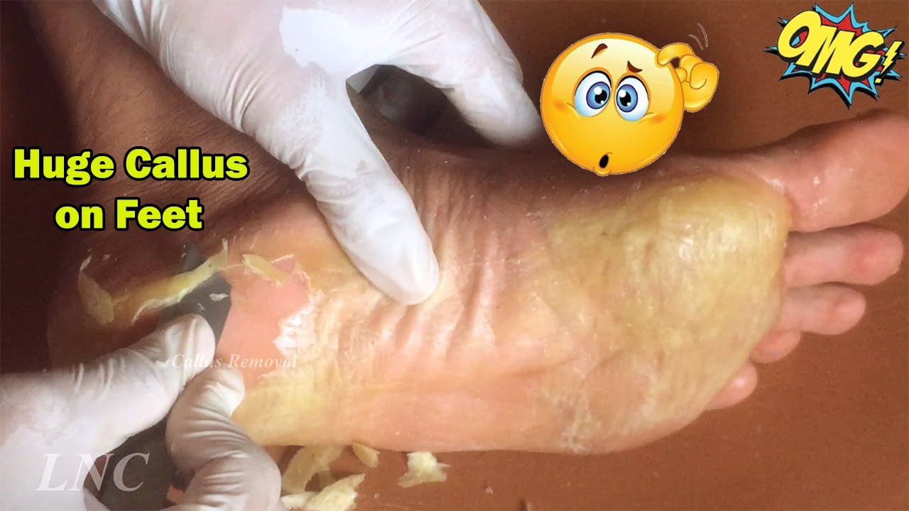 callus removal from feet satisfying 47 YouTube