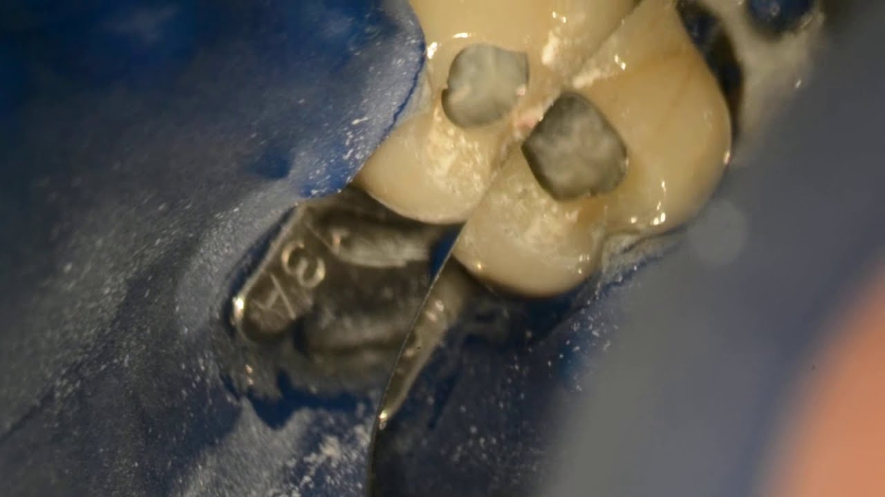Endodontic Access through the PFM Crown YouTube