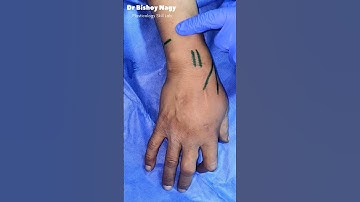 Wrist Block Landmarks - Plasticology Skill Lab