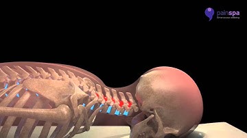 Cervical facet joint injections