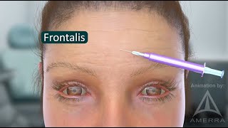 LiVDerm / Dr. Susan Weinkle - Cosmetic injection demonstration - 3d animation