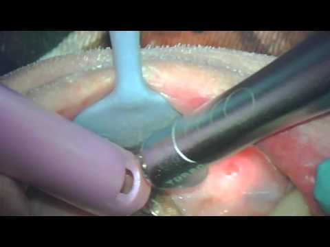 removal of bone spur alveloplasty youtube