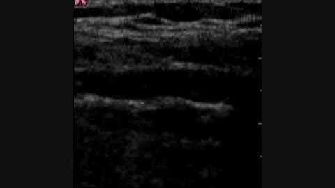 Lung sliding with GE Vscan Dual. Deslizamiento pleural. EcoUrgencias.