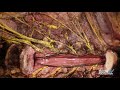 Anterior approach to the lumbar spine - Zac Tataryn, M.D.