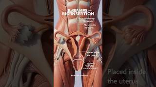 Intrauterine Device (IUD) insertion is a simple medical procedure used for long-term contraception